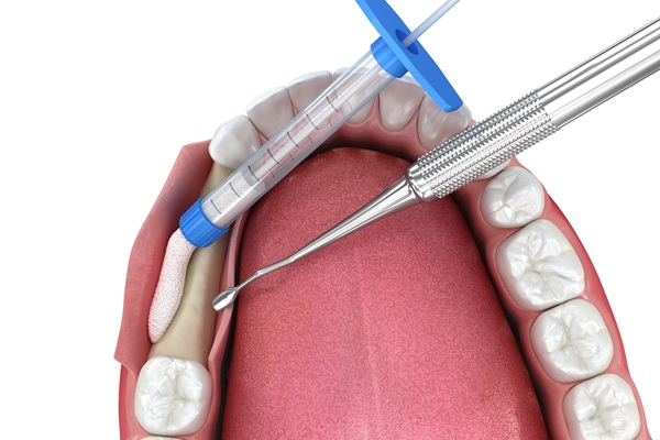 How Bone Grafts Protect Jaw Health And Expand Tooth Replacement Options