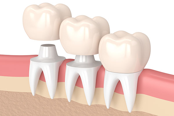 Three Tips to Deal With a Loose Dental Crown from R. David Brumbaugh, DDS in Dallas, TX