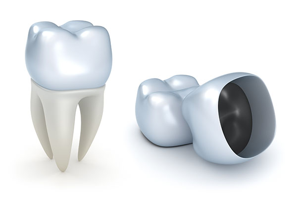 Is a Dental Crown Recommended for Dealing with a Cracked Tooth? from R. David Brumbaugh, DDS in Dallas, TX