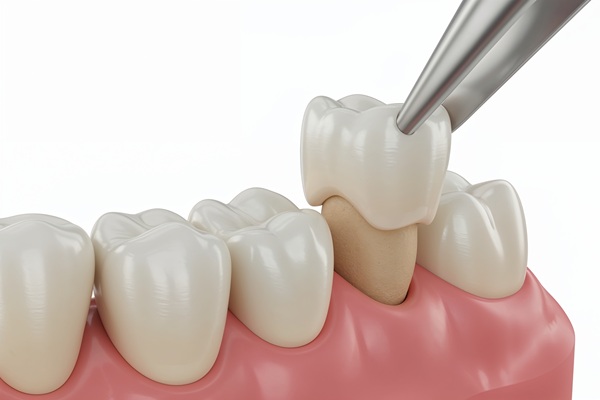 Tips To Make Your Dental Crown Last