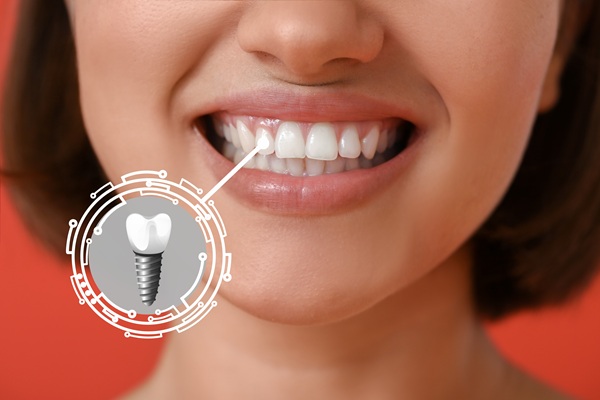 The Real Cost Of Delaying Tooth Replacement